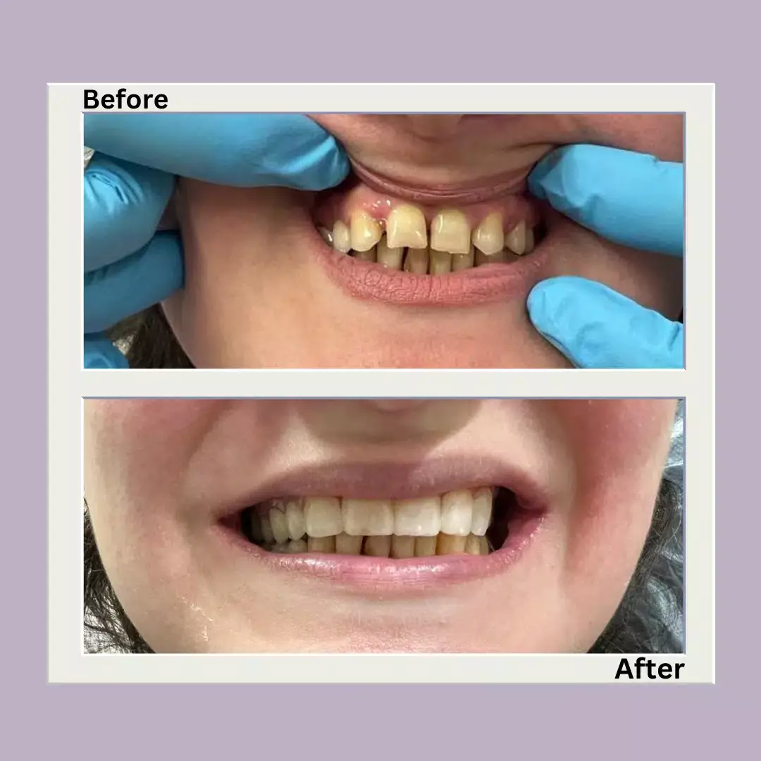 coburg-dentist-veneer