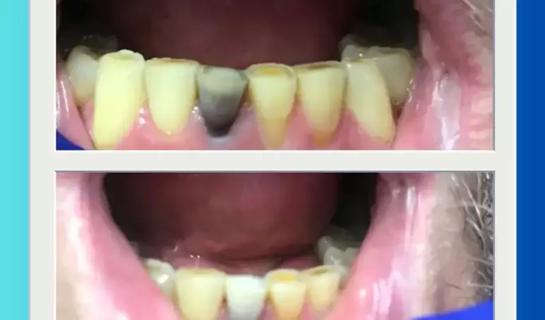 Internal-bleaching-preston-dentist