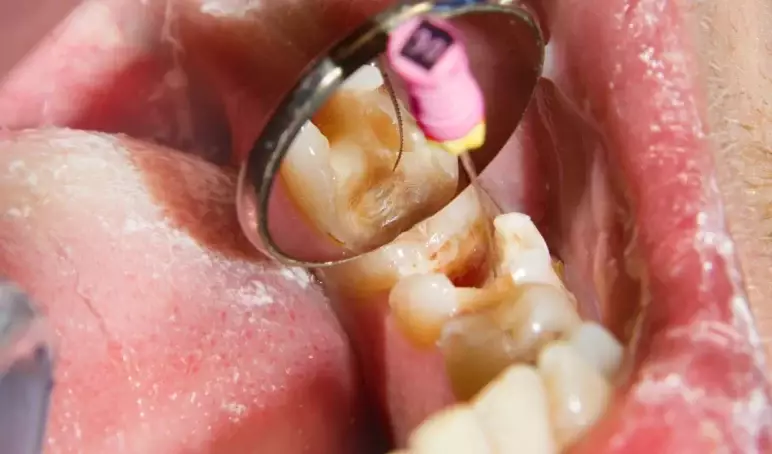 root-canal-preston